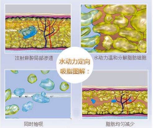 武汉水动力吸脂减肥的效果好吗?