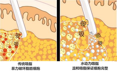 武汉水动力吸脂减肥有哪些特点?