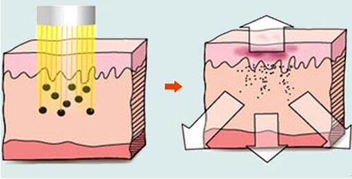 武汉激光去纹身的原理有什么