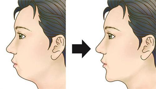 武汉通过隆下巴能改善脸型吗