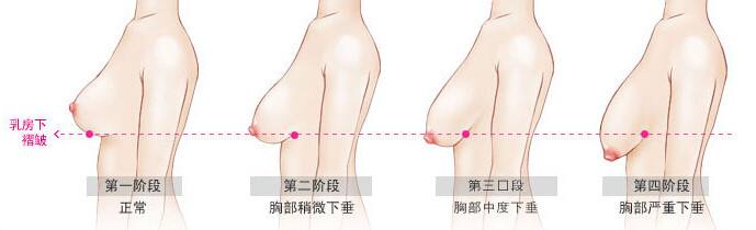 武汉胸部下垂程度不同怎么矫正