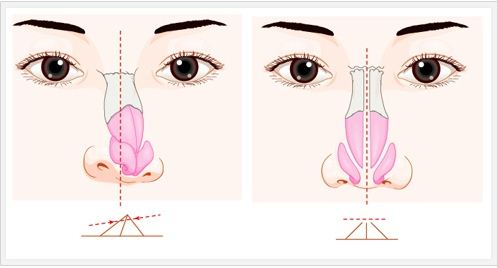武汉歪鼻矫正手术方法是什么