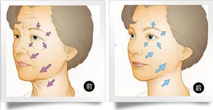 武汉电波拉皮是怎么除皱的
