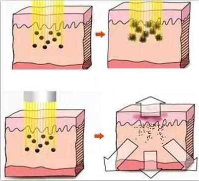 武汉激光祛斑的祛斑原理是什么
