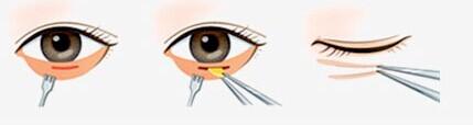 肇庆手术祛眼袋有哪些方法