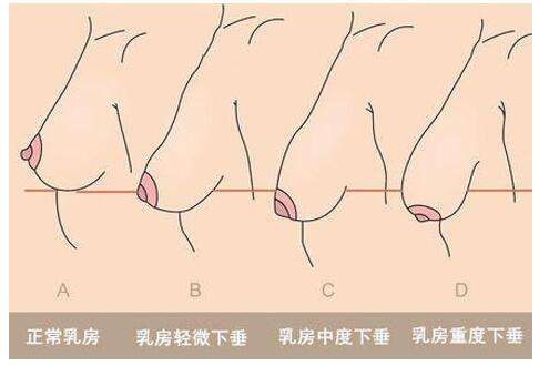 武汉乳房下垂会有什么原因