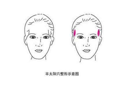 武汉填充太阳穴有哪些方法