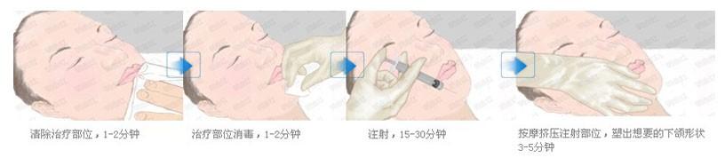 武汉下巴整形的方法有哪些