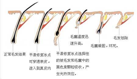 武汉冰点脱毛需要几次才能脱干净