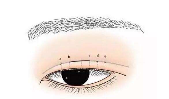 武汉割双眼皮痛不痛呢