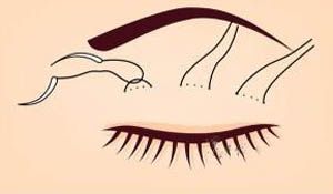 武汉常见的双眼皮手术方式有哪些