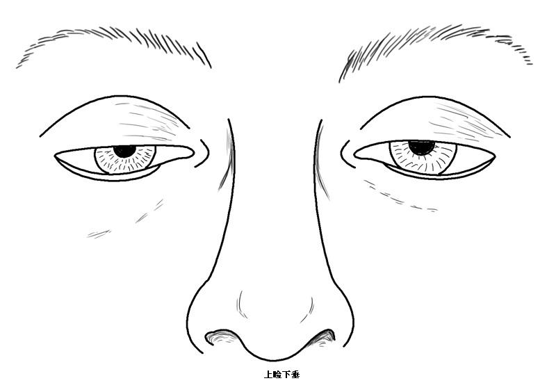 武汉怎么判断有没有上睑下垂