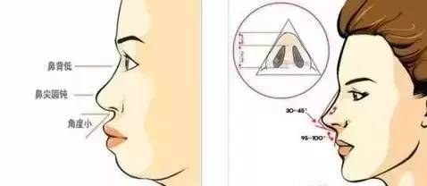 武汉做硅胶假体隆鼻优势有哪些