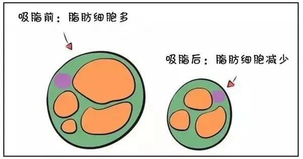 武汉腰腹吸脂会不会反弹