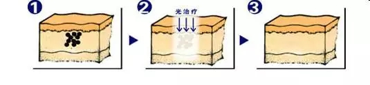 武汉可以做激光治疗黄褐斑吗