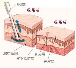 武汉做臀部吸脂哪家好