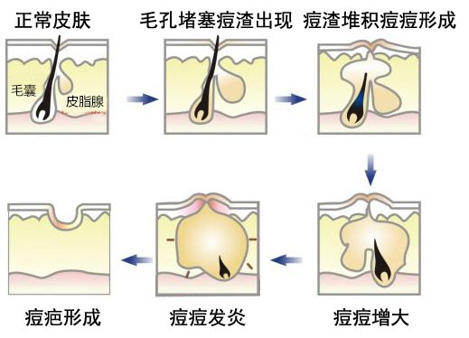 武汉红蓝光祛痘有用吗