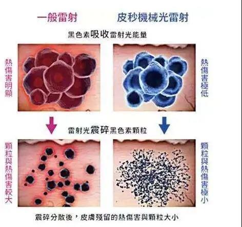 武汉超皮秒去黄褐斑疼吗