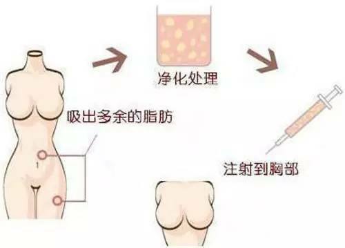 武汉自体脂肪丰胸疼吗