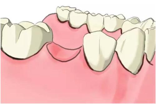 武汉什么是种植牙