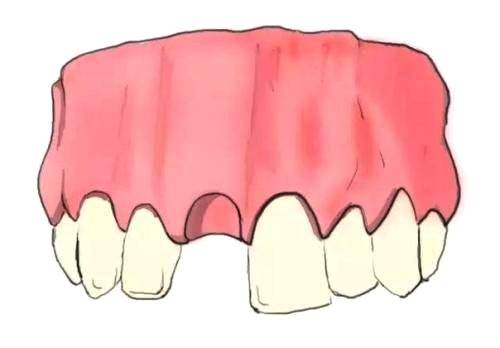 武汉种植牙能保持多久