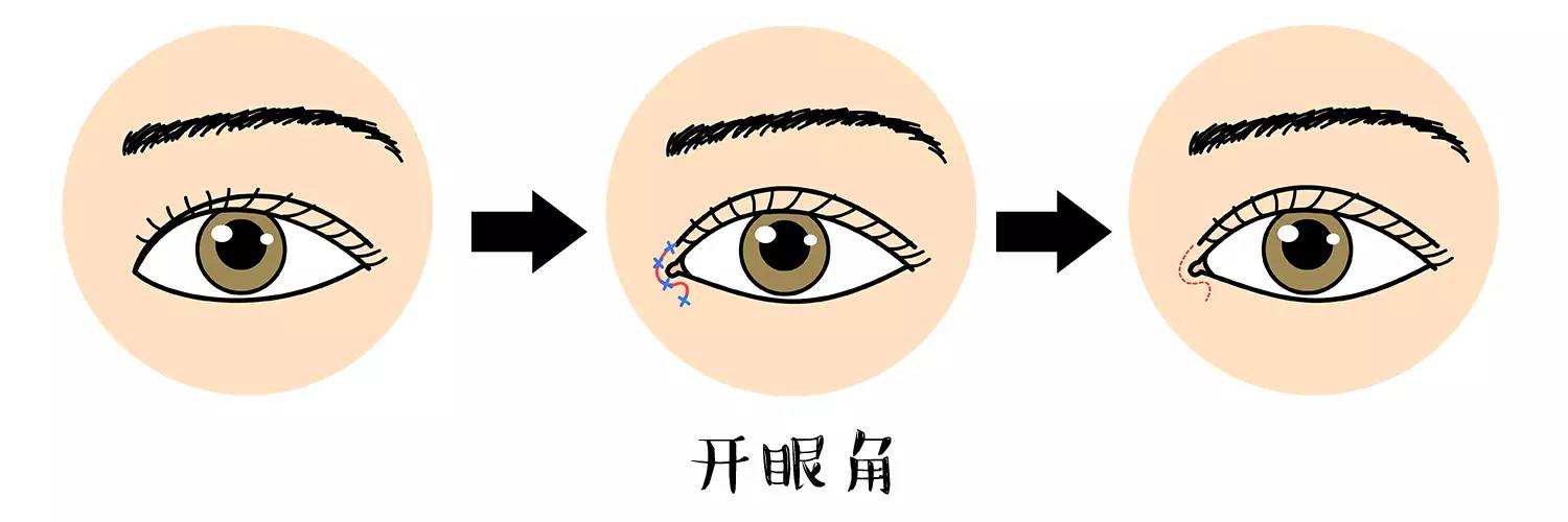 武汉开眼角多久能恢复