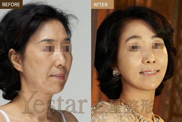 武汉botox注射除皱副作用,价格-yestar武汉艺星